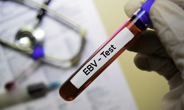 test sanguíneo de virus Epstein-Barr